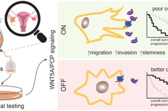 WNT signaling inducing activity in ascites predicts poor outcome in ovarian cancer