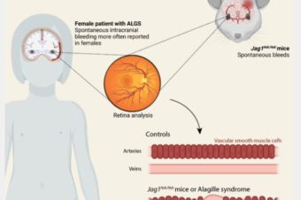 Sex differences and risk factors for bleeding in Alagille syndrome