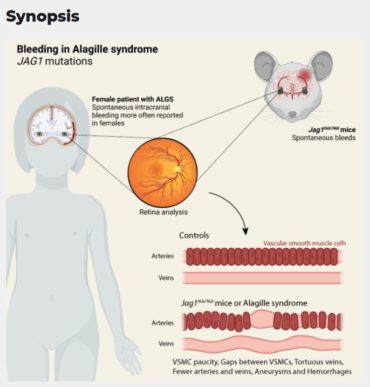 Sex differences and risk factors for bleeding in Alagille syndrome