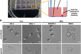 Role of casein kinase 1 in the amoeboid migration of B-cell leukemic and lymphoma cells: A quantitative live imaging in the confined environment