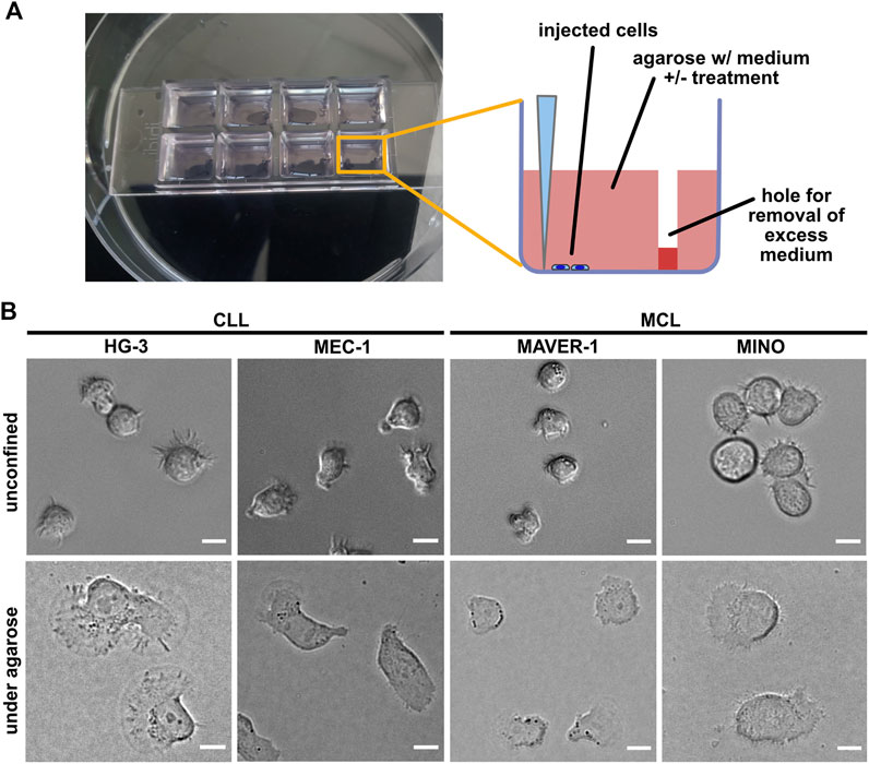 Role of casein kinase 1 in the amoeboid migration of B-cell leukemic and lymphoma cells: A quantitative live imaging in the confined environment