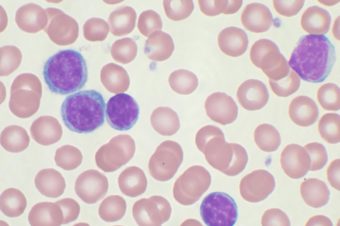 Přednáška o mikroprostředí chronické lymfocytární leukemie