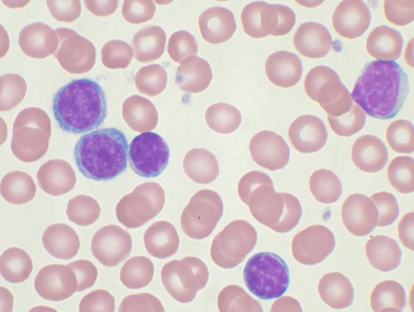 Přednáška o mikroprostředí chronické lymfocytární leukemie